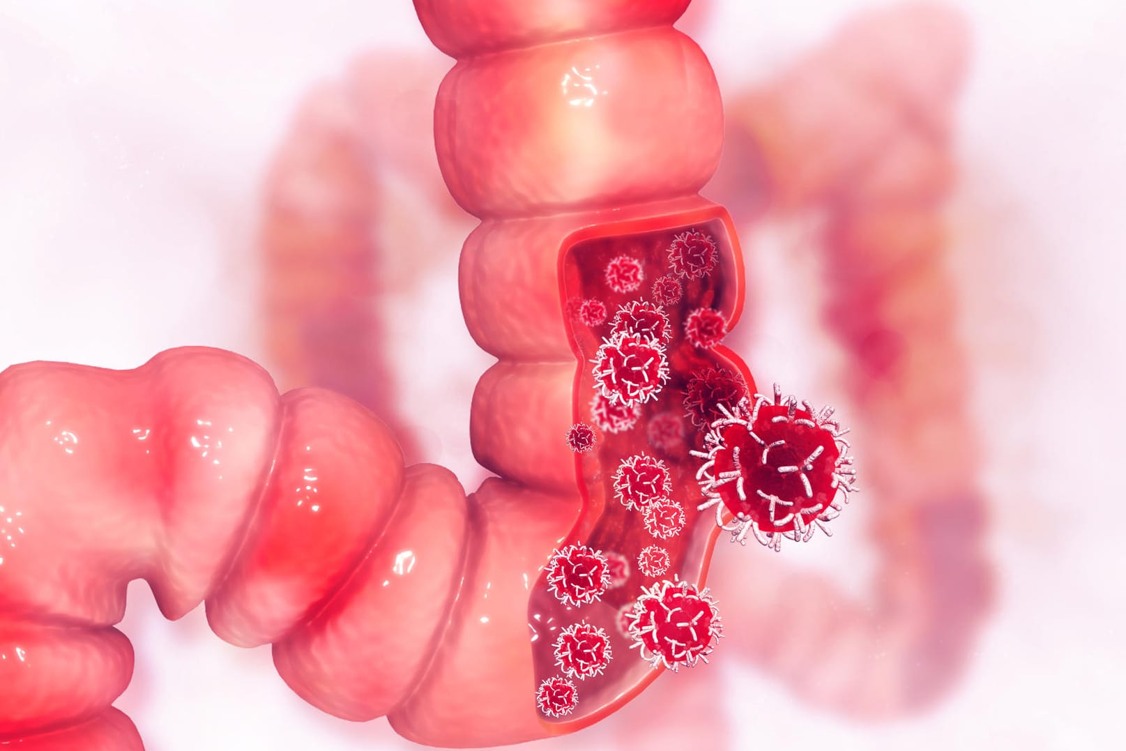 Darmkrebs: Wird die Erkrankung früh erkannt, ist sie meist heilbar.