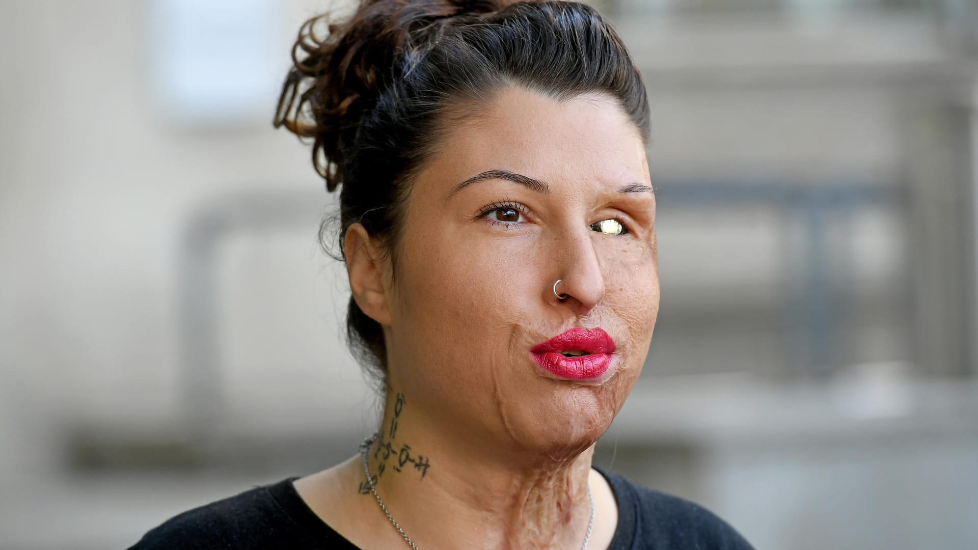 Die linke Gesichtshälfte von Vanessa Münstermann wurde zerstört: Vor zweieinhalb Jahren griff ihr Ex-Freund sie mit Säure an. Die linke Gesichtshälfte von Vanessa Münstermann wurde zerstört: Vor zweieinhalb Jahren griff ihr Ex-Freund sie mit Säure an.