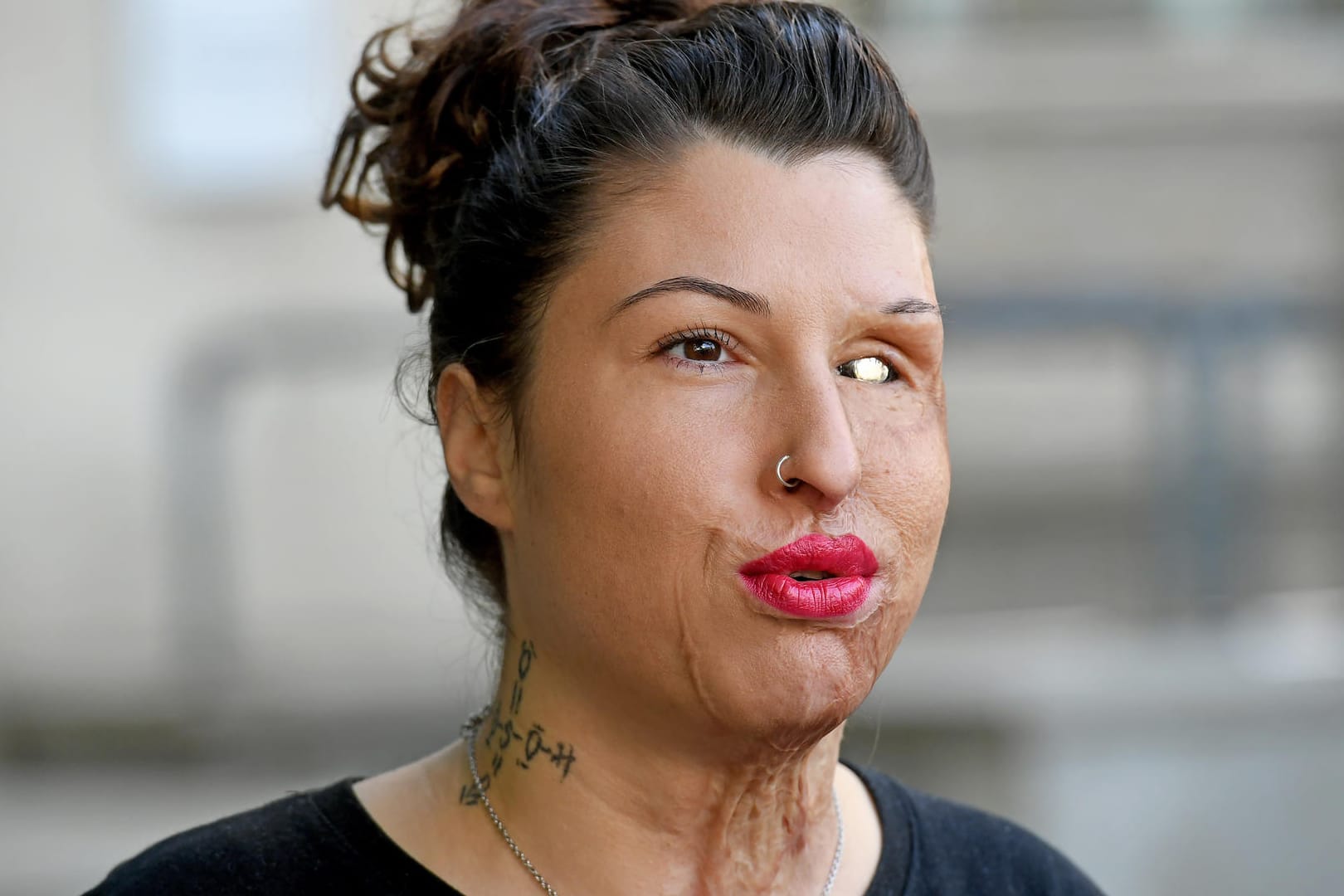 Die linke Gesichtshälfte von Vanessa Münstermann wurde zerstört: Vor zweieinhalb Jahren griff ihr Ex-Freund sie mit Säure an.
