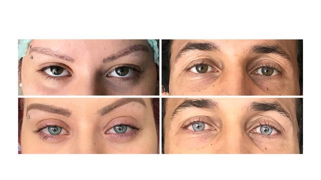 Erst braun, dann blau: Mit einem Femtosekundenlaser verändert der Augenchirurg Francis Ferrari die Augenfarbe seiner Patienten. Erst braun, dann blau: Mit einem Femtosekundenlaser verändert der Augenchirurg Francis Ferrari die Augenfarbe seiner Patienten.