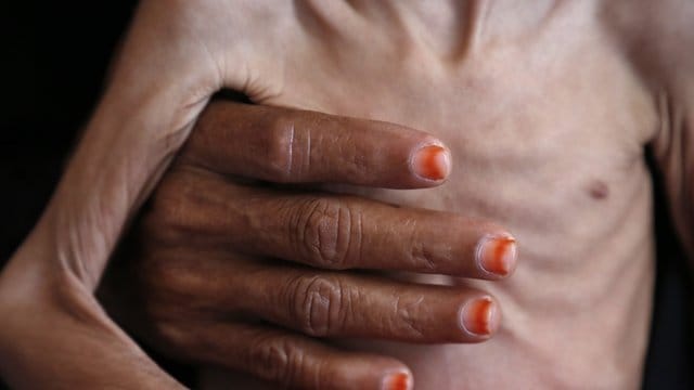 Eine Frau hält ein unterernährtes Kind in einem Krankenhaus in der Provinz Hadscha im Jemen. Eine Frau hält ein unterernährtes Kind in einem Krankenhaus in der Provinz Hadscha im Jemen.