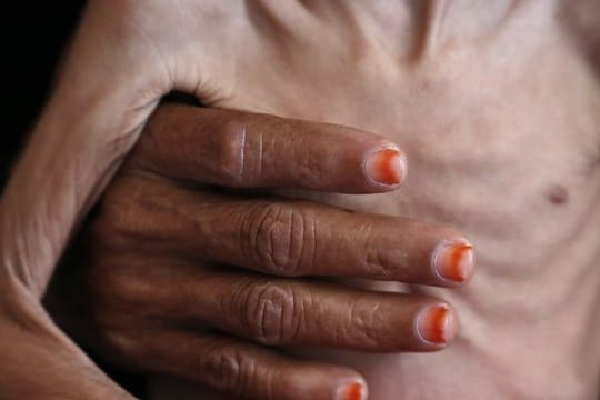 Eine Frau hält ein unterernährtes Kind in einem Krankenhaus in der Provinz Hadscha im Jemen.