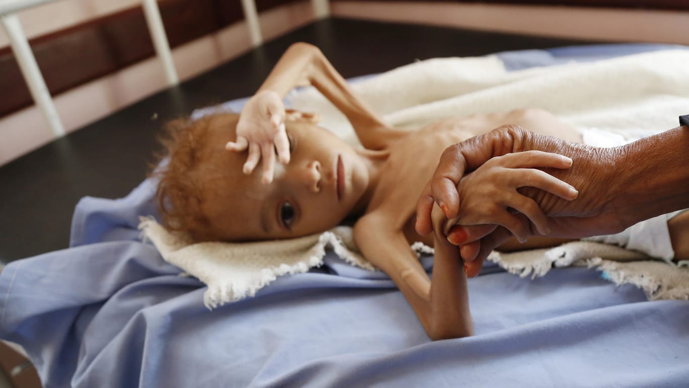 Ein unterernährtes Kind: Am schlimmsten ist die Hungersnot in der Zentralafrikanischen Republik.