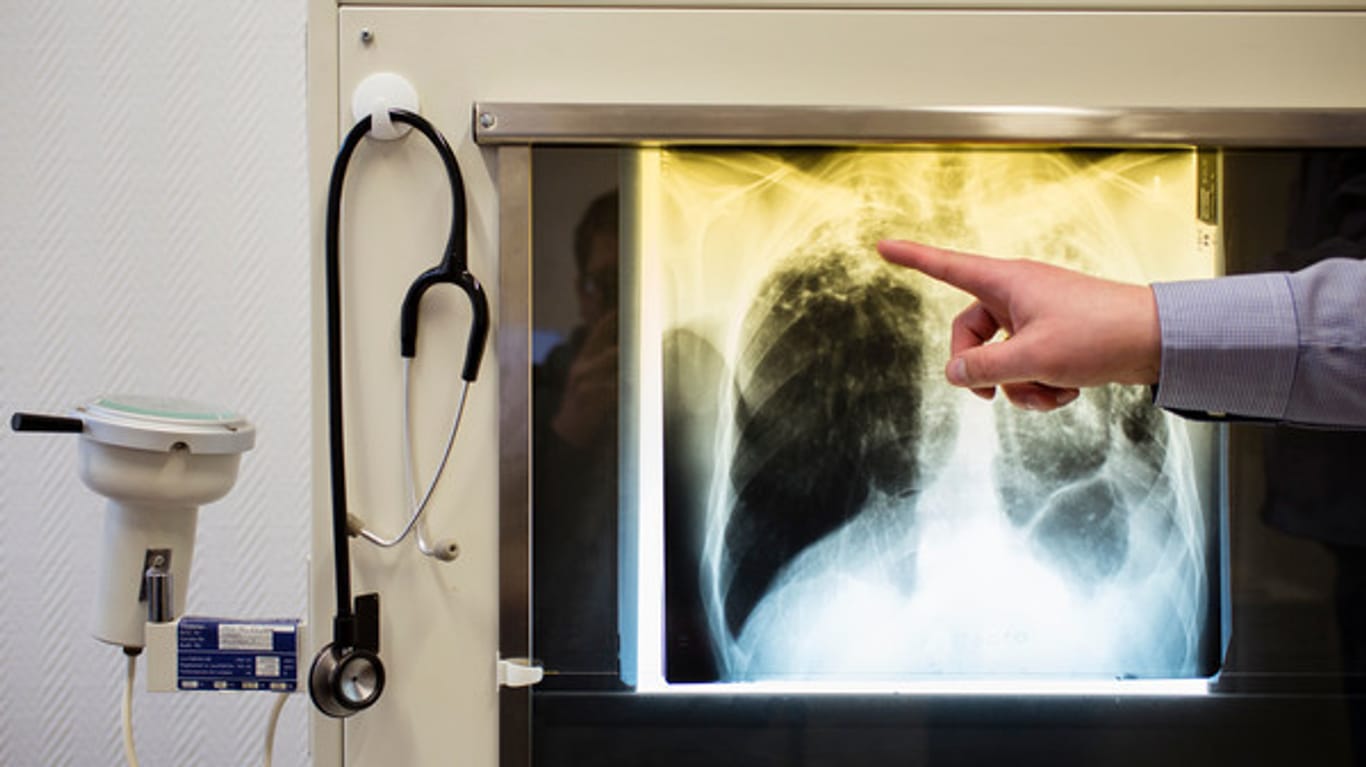 Ein Tuberkulose-Fall auf einem Röntgenbild im Tuberkulosezentrum Berlin-Lichtenberg. Nach einem Anstieg seit 2015 sinken die Zahlen wieder.