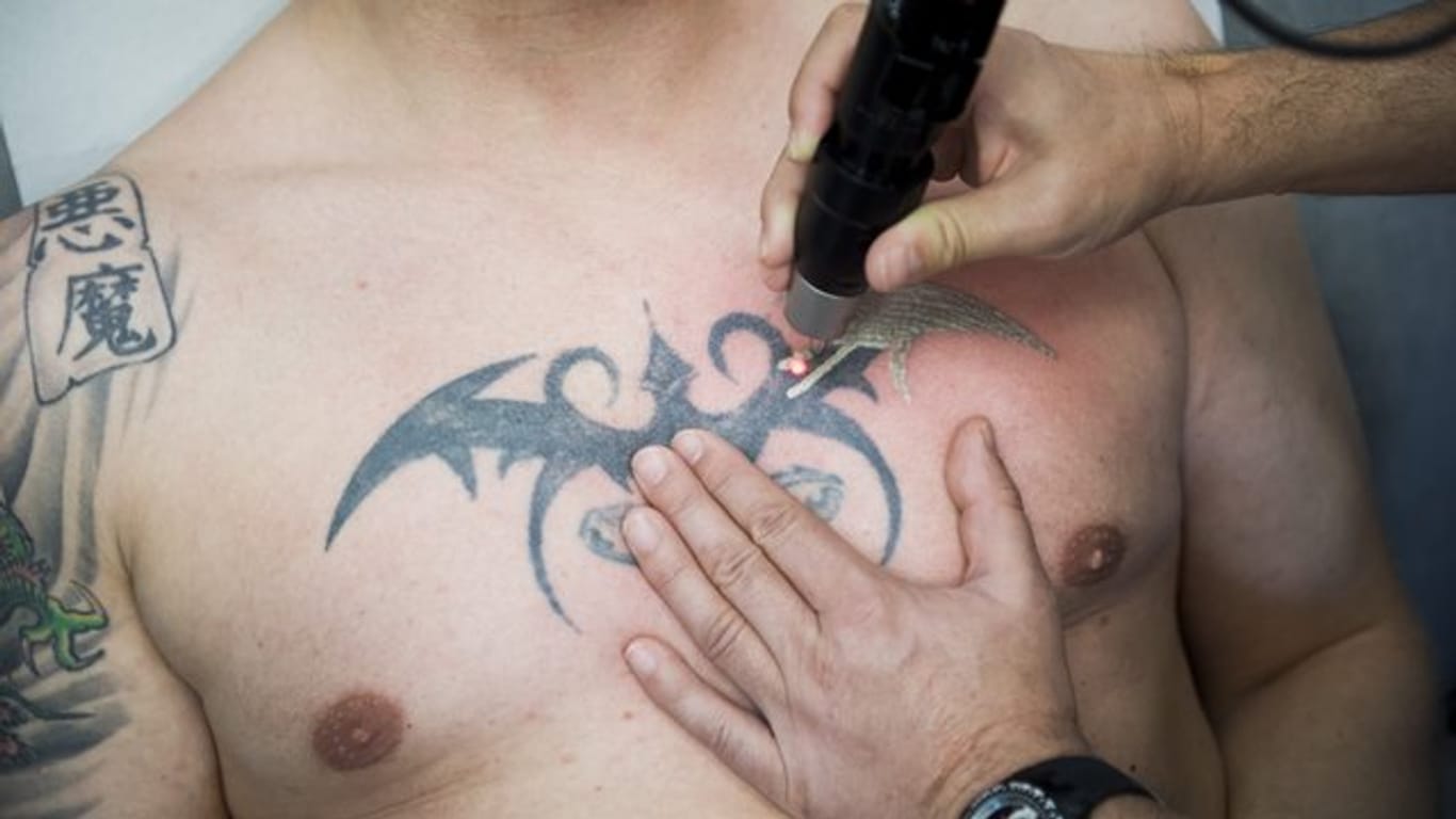In der Universitätsklinik Bochum entfernt ein Arzt mit einem Laser ein Tattoo auf der Brust eines Mannes.