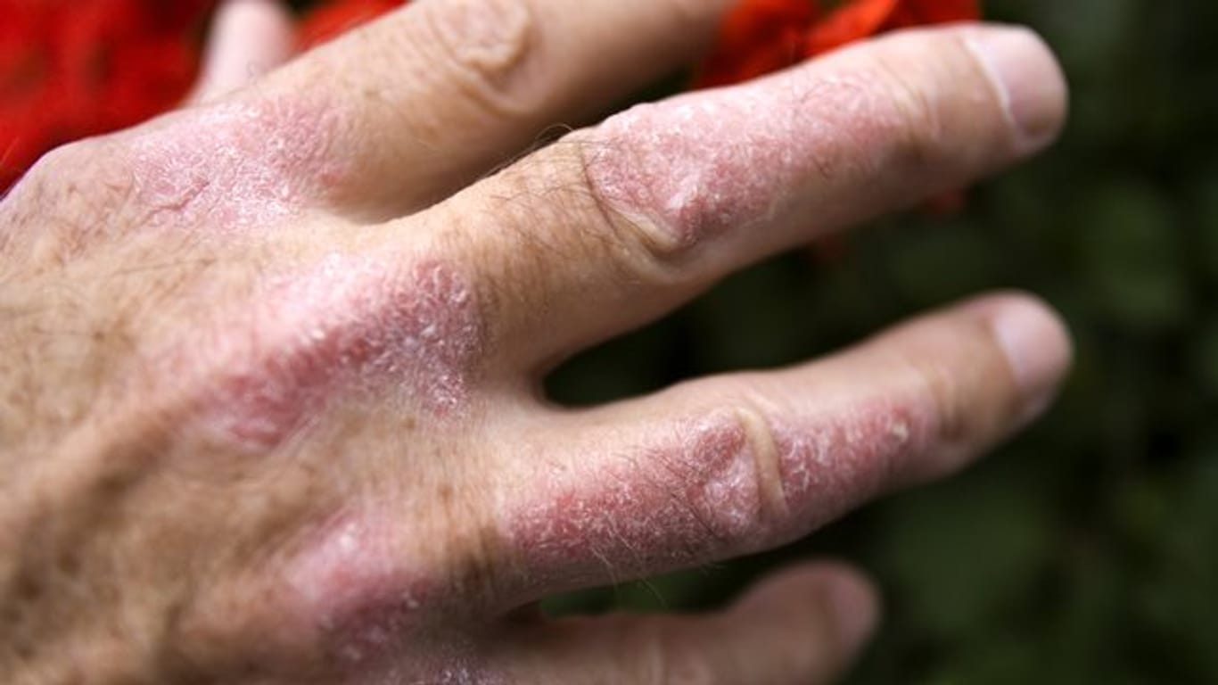 Schuppenflechte (Psoriasis) an der Hand eines Mannes.