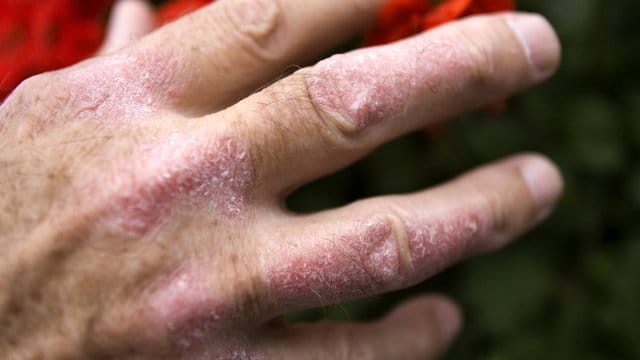 Schuppenflechte (Psoriasis) an der Hand eines Mannes.