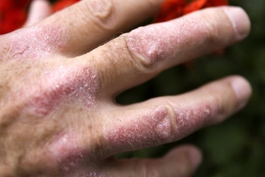 Schuppenflechte (Psoriasis) an der Hand eines Mannes.