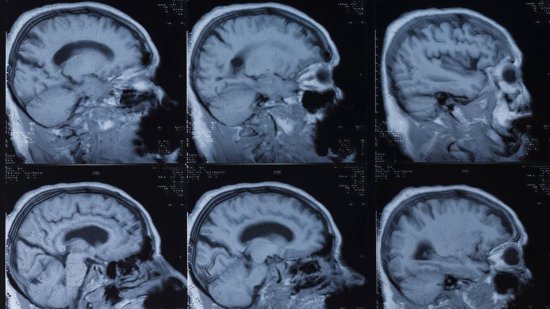 Menschliches Gehirn in MRT-Aufnahmen: KI kann Alzheimer Jahre früher erkennen.