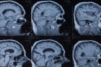 Menschliches Gehirn in MRT-Aufnahmen: KI kann Alzheimer Jahre früher erkennen.
