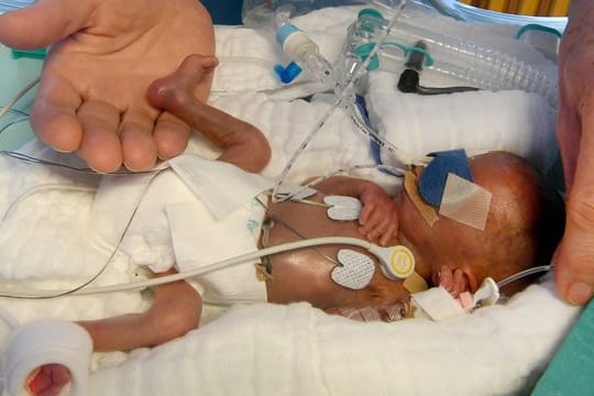 In der Hand einer Pflegekraft liegt der Fuß eines fünf Tage alten und bei der Geburt 430 Gramm wiegenden Jungen in der Kinderklinik der Medizinischen Hochschule Hannover.