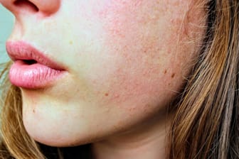 Gerötete Haut: Beim Verzehr der Trinkampullen kann es zu allergischen Reaktionen kommen.