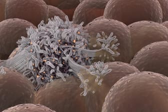 Ausbreitung von Krebszellen unter gesunden Stammzellen.