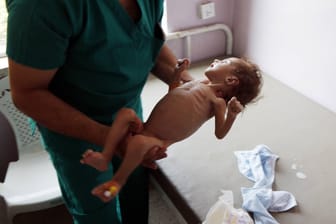 Ein unterernährtes Kind in einem Krankenhaus in Jemen: In dem Land im Nahen Osten hungern 20 Millionen Menschen.