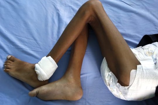 Ein unterernährtes Kind liegt in einem Krankenhaus in Hudaida.