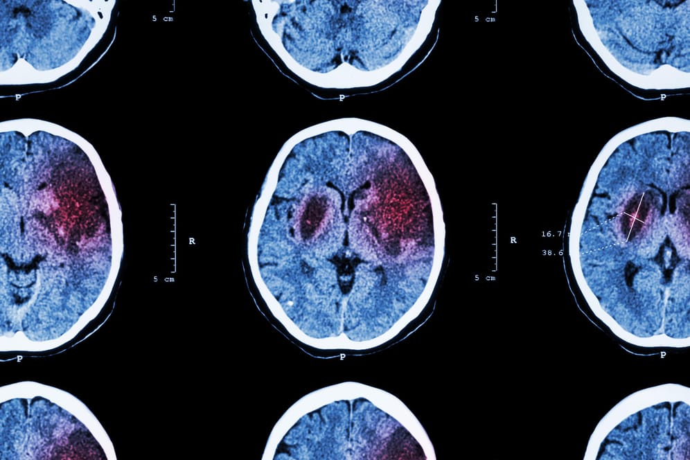MRT vom Gehirn: Ein Schlaganfall ist eine Durchblutungsstörung im Gehirn.