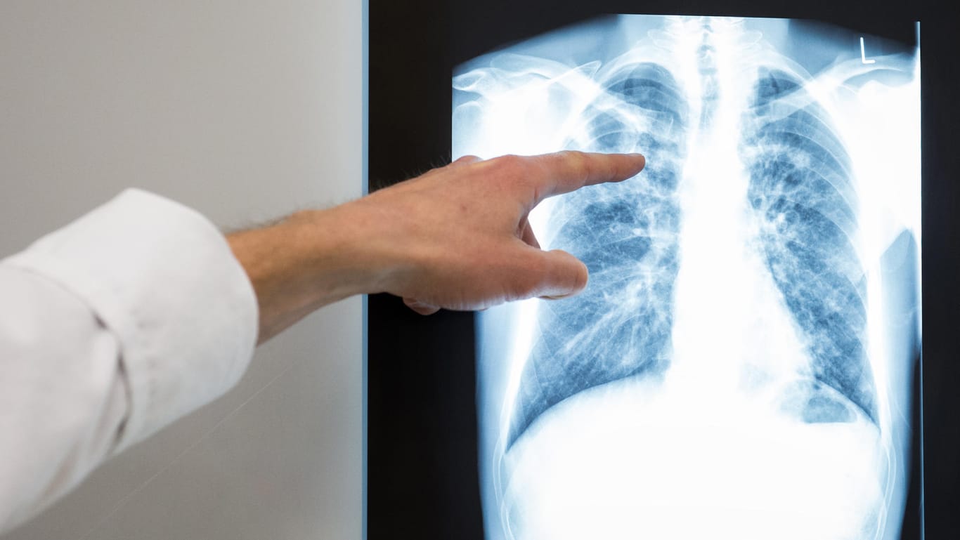 Röntgenbild einer Lunge: Eine Gruppe deutscher Lungenspezialisten bezweifelt den gesundheitlichen Nutzen der aktuellen Grenzwerte für Feinstaub und Stickoxide. International Fachärzte halten dagegen.