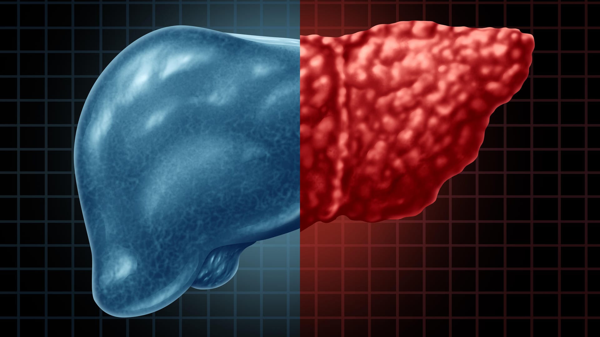 Verfettete Leber: Viele Erwachsene leiden darunter – ohne es zu wissen.