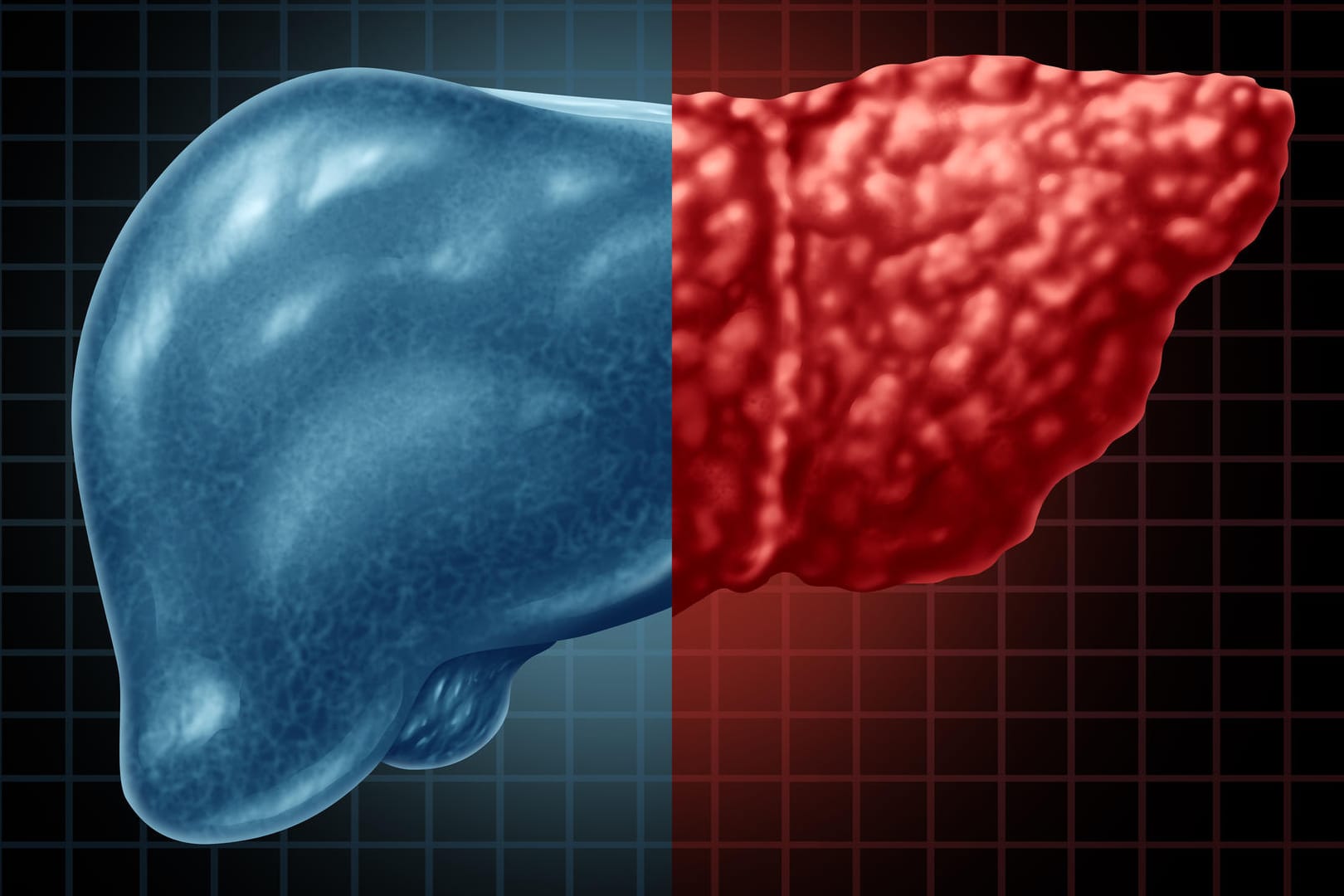 Verfettete Leber: Viele Erwachsene leiden darunter – ohne es zu wissen.
