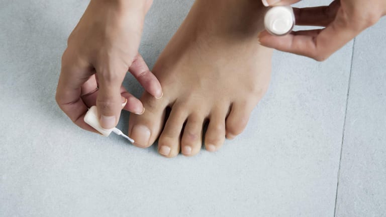 Frau lackiert Fußnägel: Die Bekämpfung von Nagelpilz kann Monate dauern.