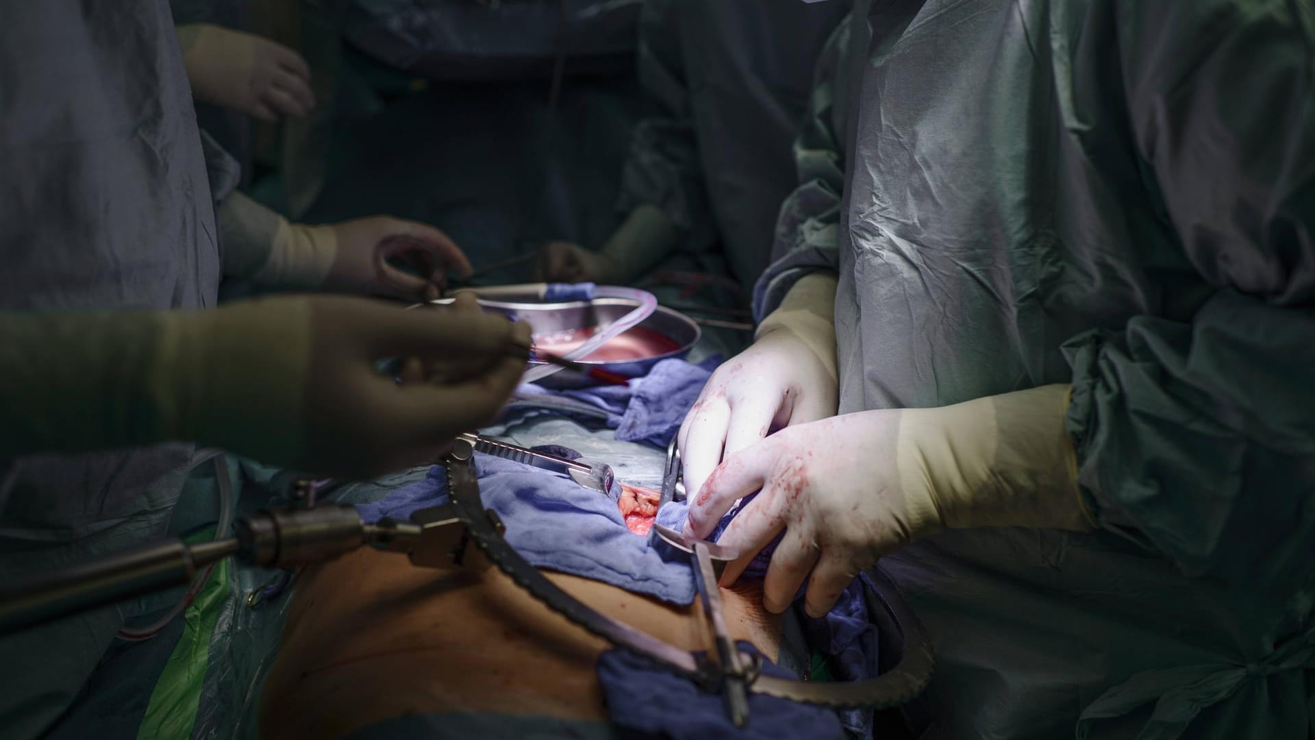 Organtransplantation Organtransplantation