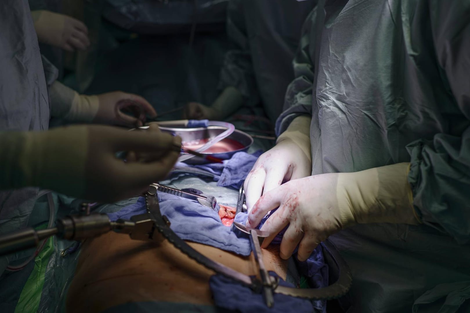 Organtransplantation