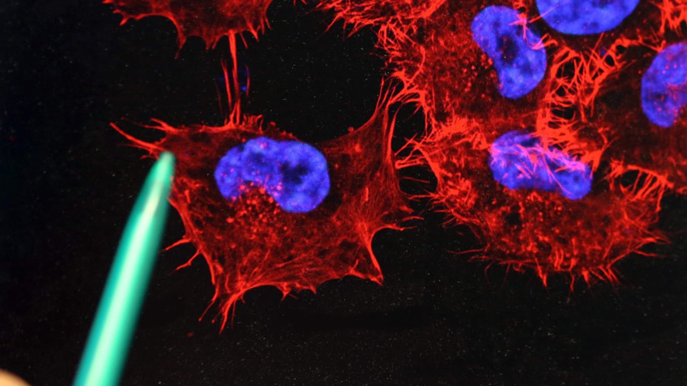 Bild von Melanom-Zellen (schwarzer Hautkrebs): Rund 230.000 Menschen sterben jährlich an Krebs.