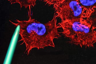 Bild von Melanom-Zellen (schwarzer Hautkrebs): Rund 230.000 Menschen sterben jährlich an Krebs.