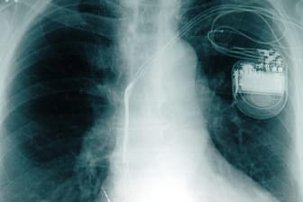 Die Röntgenaufnahme einer Brust, in der ein Herzschrittmacher sitzt: Hacker könnten die Geräte starke Stromimpulse abgeben lassen, für den Patitenten könnte das tödlich enden. (Archivbild)