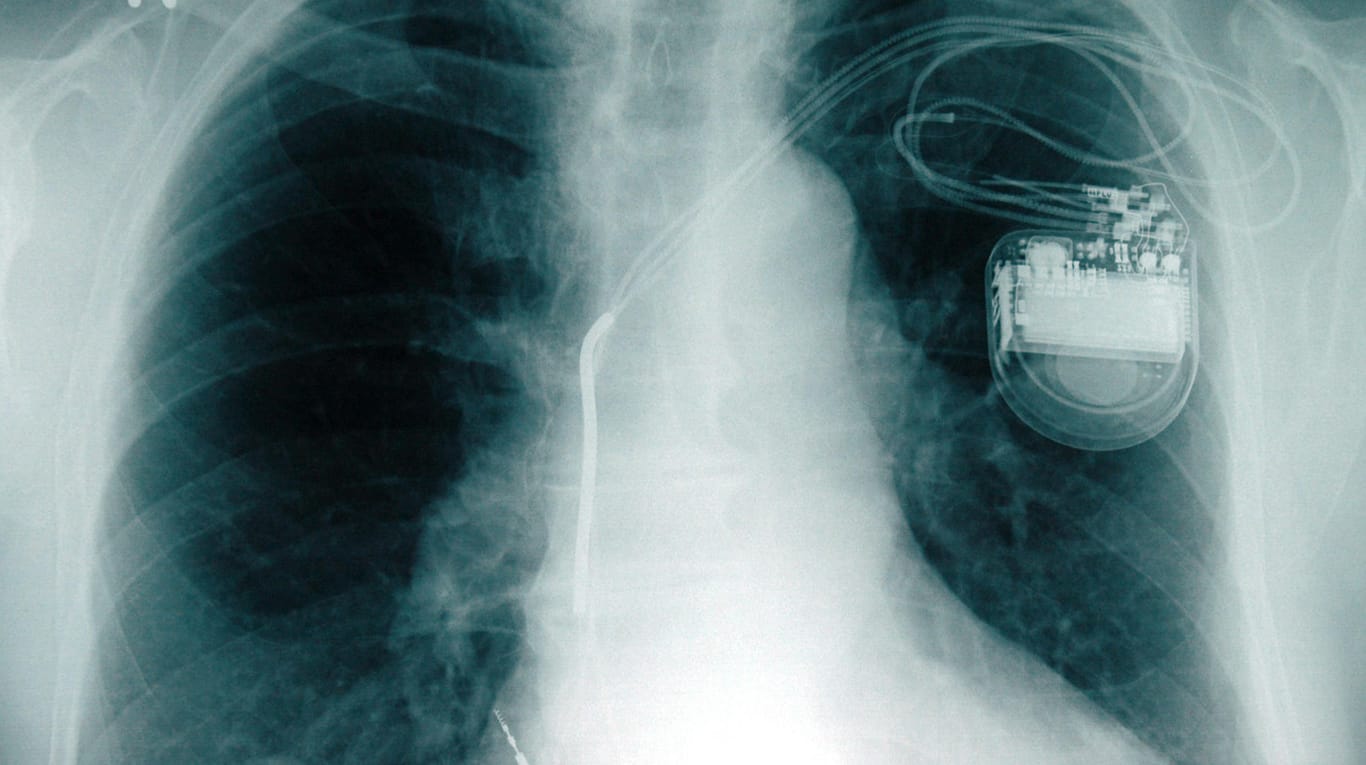 Die Röntgenaufnahme einer Brust, in der ein Herzschrittmacher sitzt: Hacker könnten die Geräte starke Stromimpulse abgeben lassen, für den Patitenten könnte das tödlich enden. (Archivbild)
