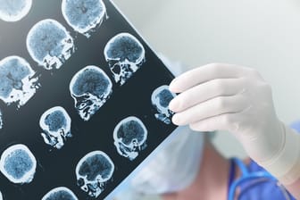 EEG-Bild: Ein einzelner Anfall bedeutet nicht zwangsläufig Epilepsie.