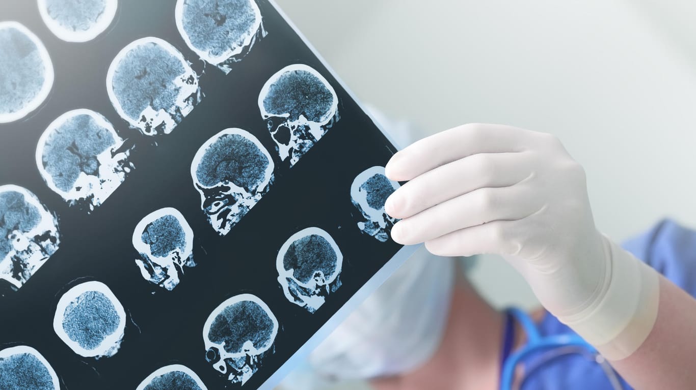 EEG-Bild: Ein einzelner Anfall bedeutet nicht zwangsläufig Epilepsie.
