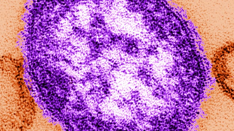 Teile eines Masernvirus: Es kann das Gehirn befallen und ist deshalb lebensgefährlich.