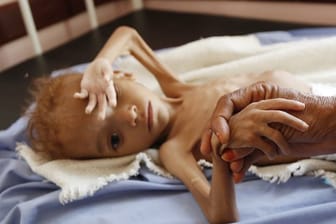 Ein stark unterernährtes Kind in der jemenitischen Provinz Hadscha: Das blockierte Getreide könnte 3,7 Millionen Menschen einen Monat lang ernähren (Archivbild)