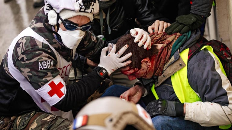 Ein verletzter Demonstrant: 20 Menschen sollen bereits ein Auge verloren haben.