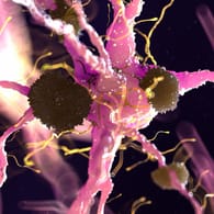 Diese Grafik zeigt, wie Alzheimer entsteht: Eiweißablagerungen bilden sich zwischen den Nervenzellen und verklumpen sie. Damit einher geht ein Verlust der geistigen Fähigkeiten.