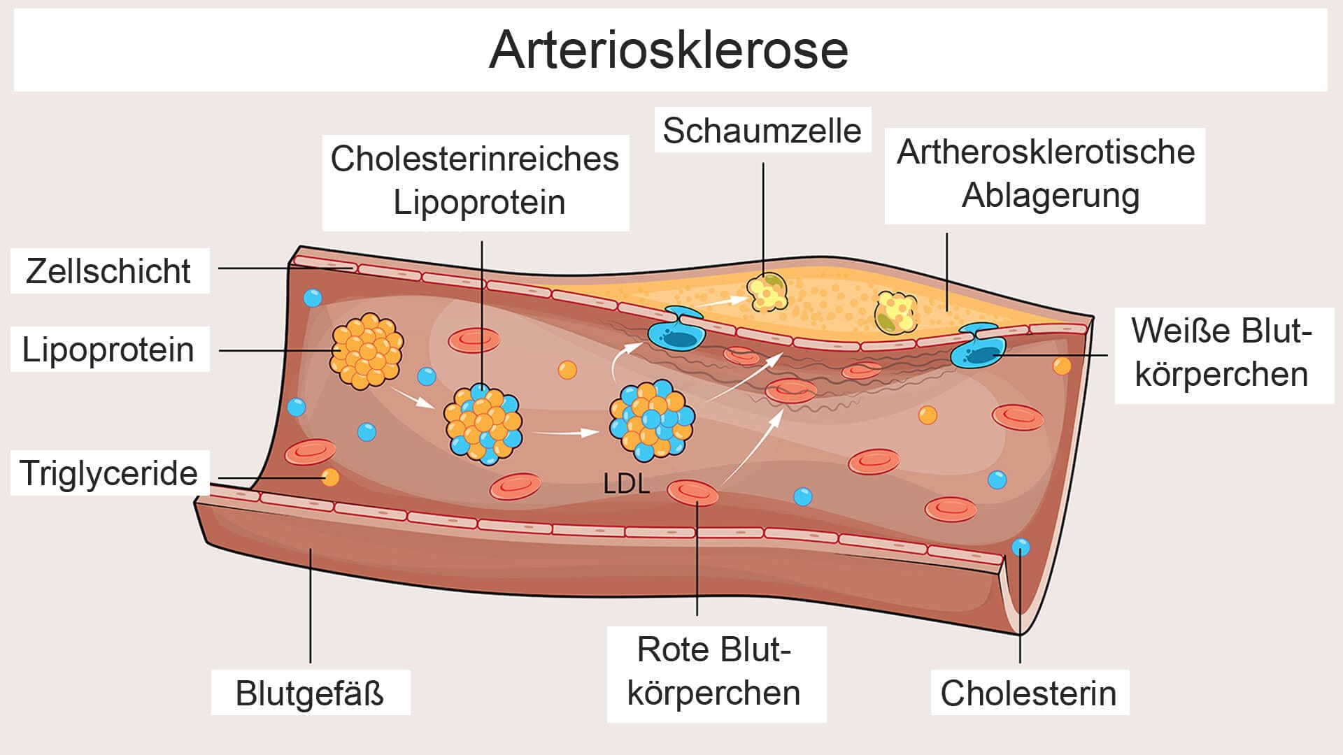 Die Grafik zeigt, wie das LDL und weitere cholesterinhaltige Lipoproteine an der Entstehung von Arteriosklerose beteiligt sind und zu Ablagerungen in den Blutgefäßen führen.