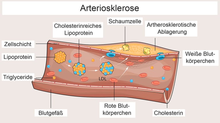 Die Grafik zeigt, wie das LDL und weitere cholesterinhaltige Lipoproteine an der Entstehung von Arteriosklerose beteiligt sind und zu Ablagerungen in den Blutgefäßen führen.