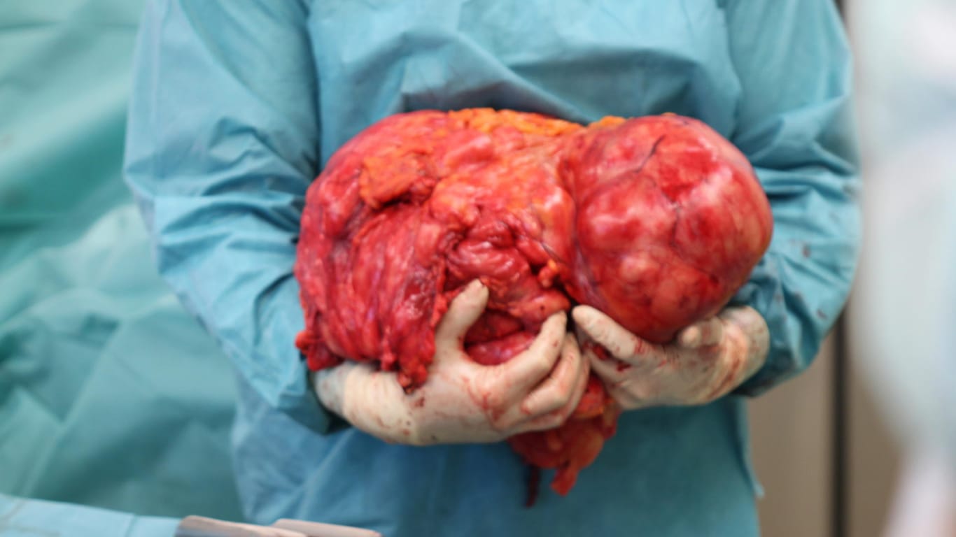 Ein Chirurg hält einen 15 Kilogramm schweren Tumor in der Hand