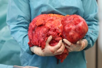 Ein Chirurg hält einen 15 Kilogramm schweren Tumor in der Hand