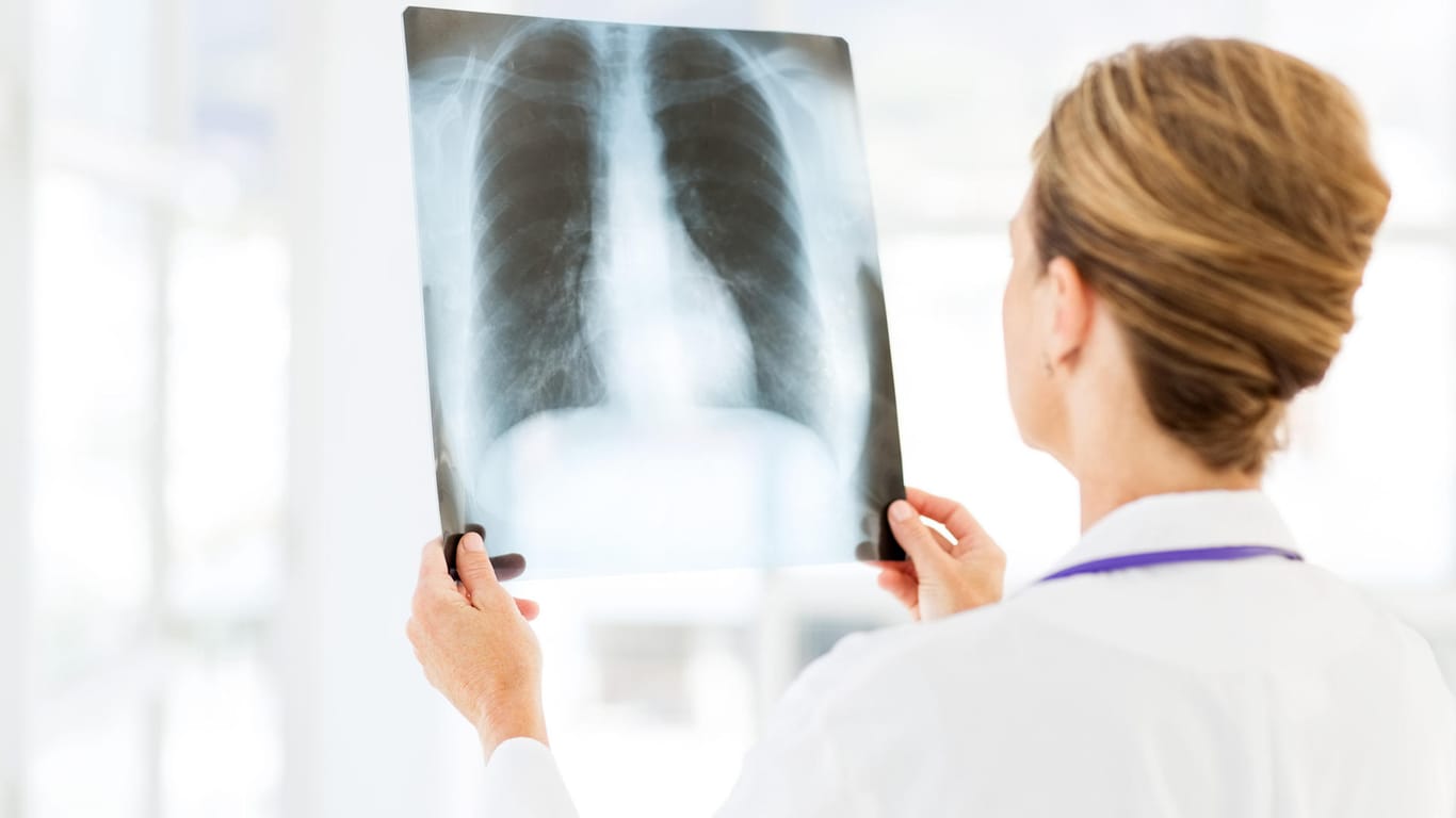 Röntgenbild der Lunge: 2017 gab es in Berlin 418 Tuberkulose Neuerkrankungen, Platz eins in Deutschland.