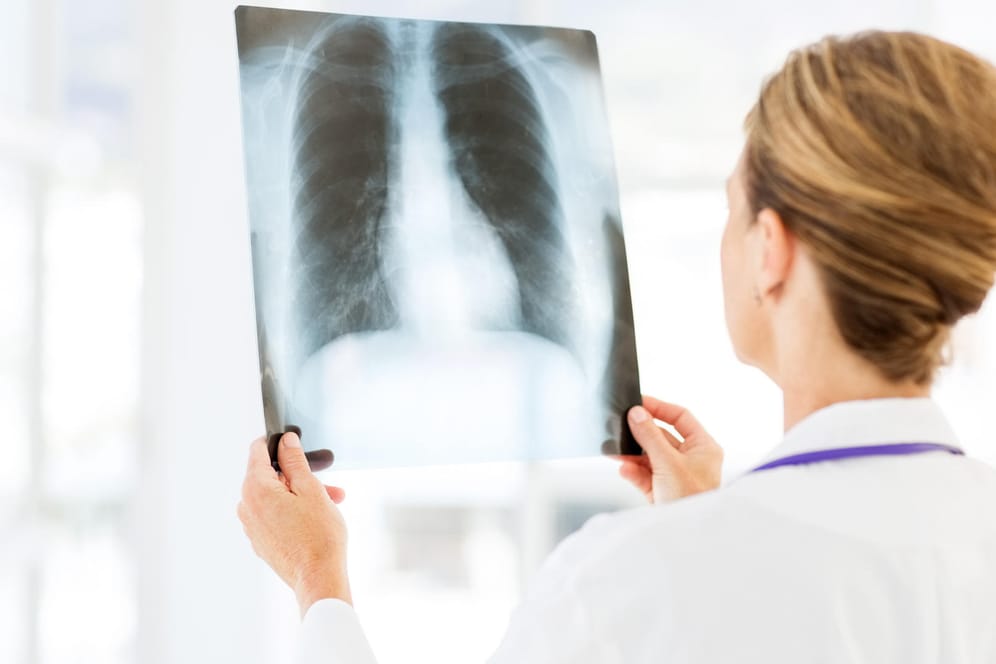 Röntgenbild der Lunge: 2017 gab es in Berlin 418 Tuberkulose Neuerkrankungen, Platz eins in Deutschland.