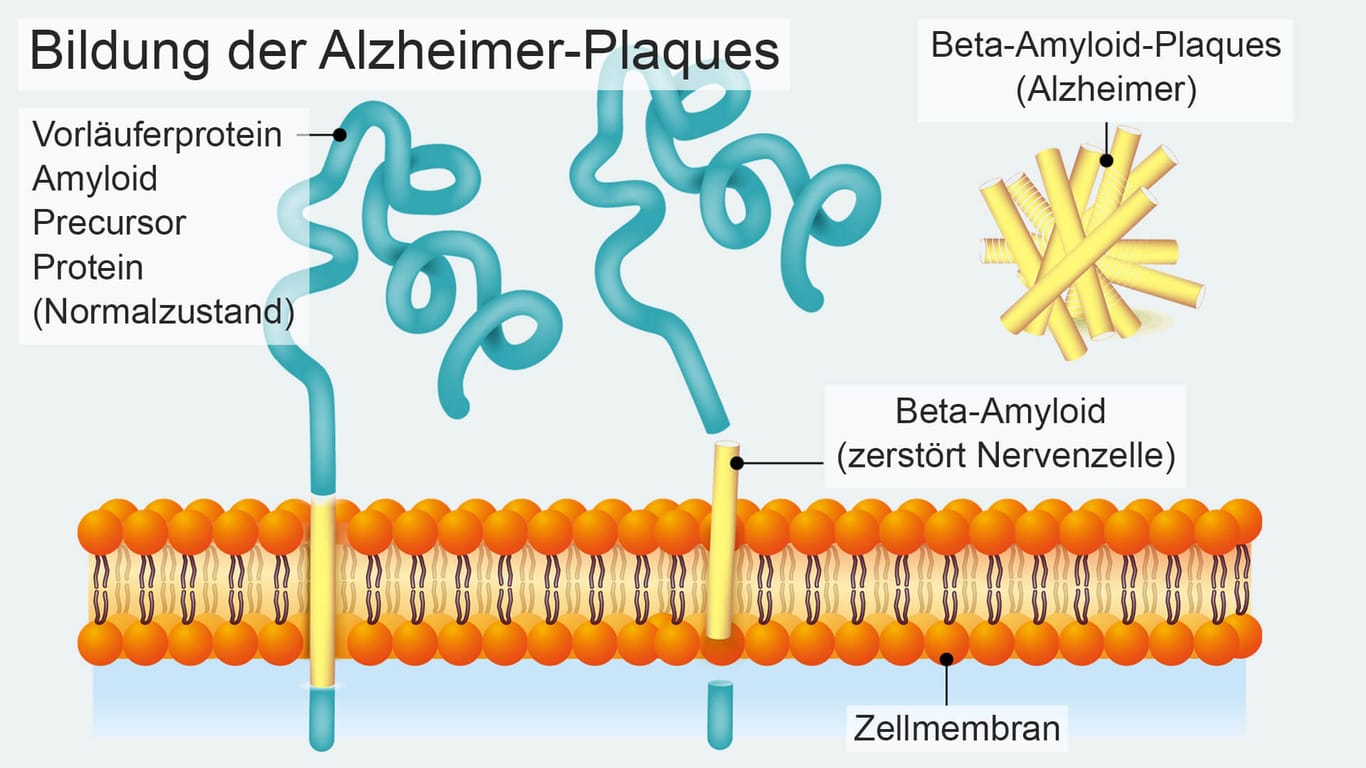 Beta-Amyloid wird aus einem größeren Vorläuferprotein (Amyloid Precursor Protein) abgespalten. An das Peptid lagern sich weitere Peptidfragmente an, so dass Ablagerungen entstehen, die die Funktion der Nervenzellen beeinträchtigen und diese schließlich zerstören.