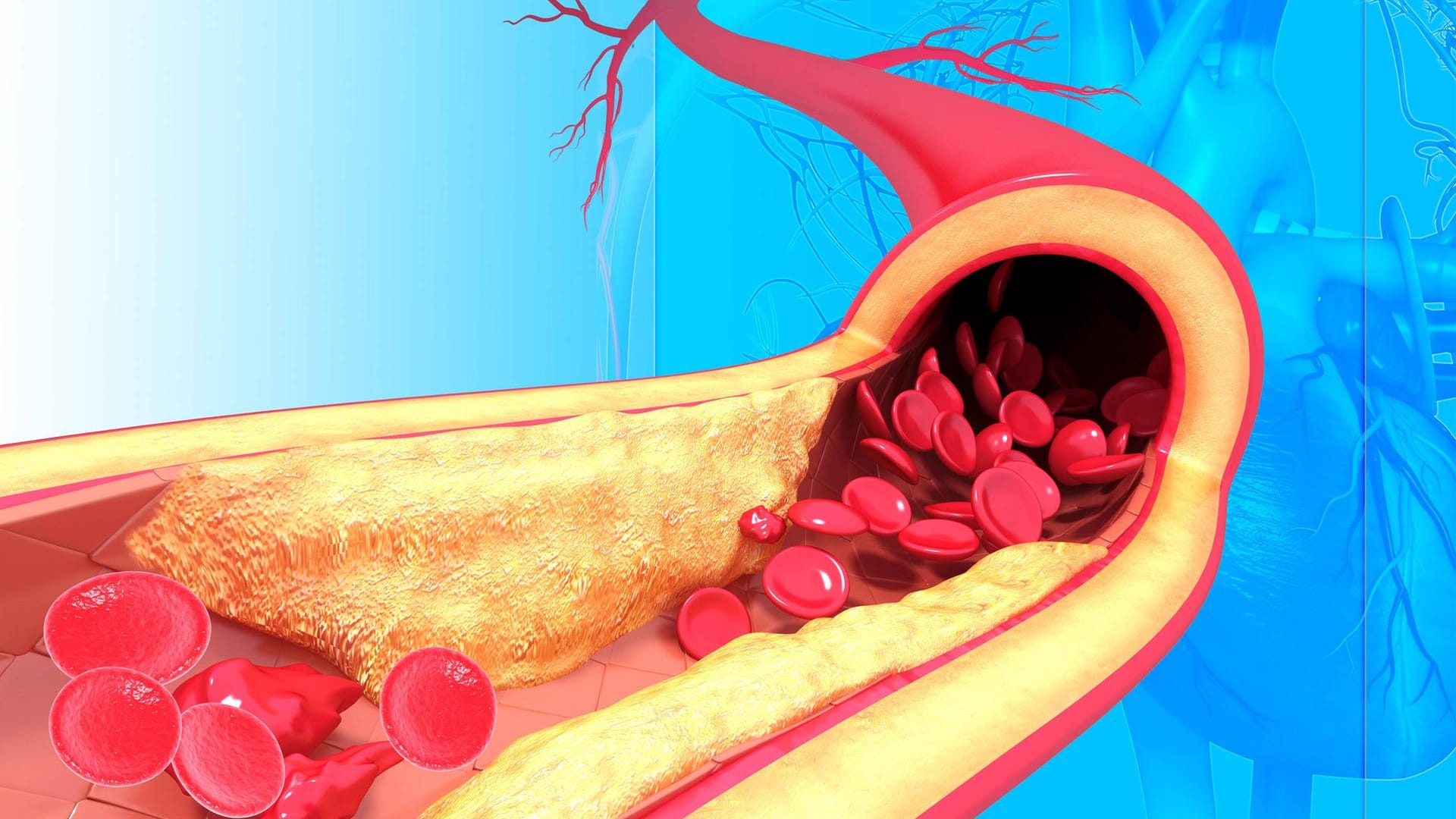 Verengte Arterie mit Plaque: Ablagerungen an der Gefäßwand können gefährlich werden.