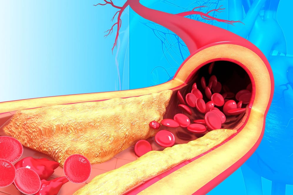 Verengte Arterie mit Plaque: Ablagerungen an der Gefäßwand können gefährlich werden.