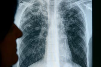 Röntgenaufnahme eines an Tuberkulose erkrankten Patienten.