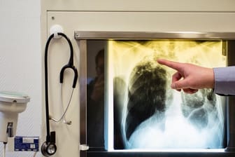Röntgenbild: Obwohl Tuberkulose eine vermeidbare und heilbare Krankheit ist, verursacht sie immer noch den Tod vieler Menschen in der EU.