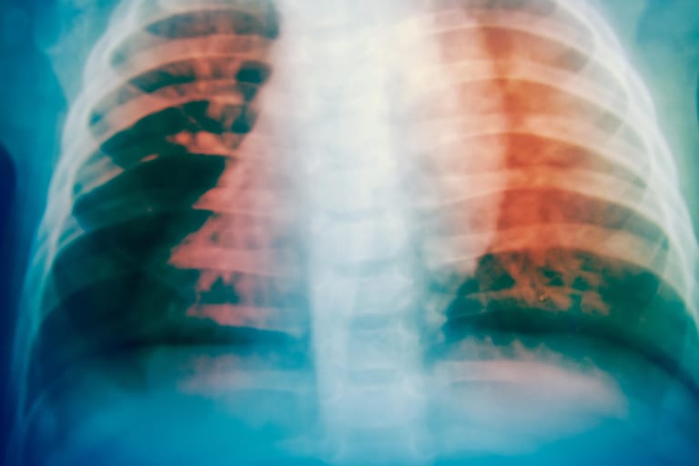 Röntgenbild der Lunge: Tuberkulose-Bakterien haben sich ausgebreitet.