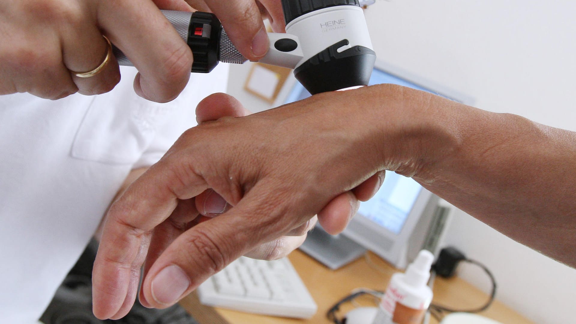 Ein Hautarzt untersucht die Haut einer Patientin: Jedes Jahr stellen Dermatologen rund 21.000 neue Hautkrebserkrankungen fest. (Symbolbild)