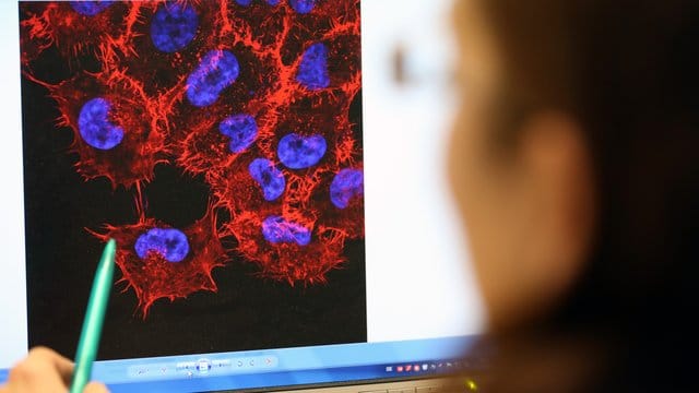 Dermatologen rechnen für die nächsten 30 Jahre mit einem deutlichen Anstieg aller Hautkrebs-Arten in Deutschland. Dermatologen rechnen für die nächsten 30 Jahre mit einem deutlichen Anstieg aller Hautkrebs-Arten in Deutschland.